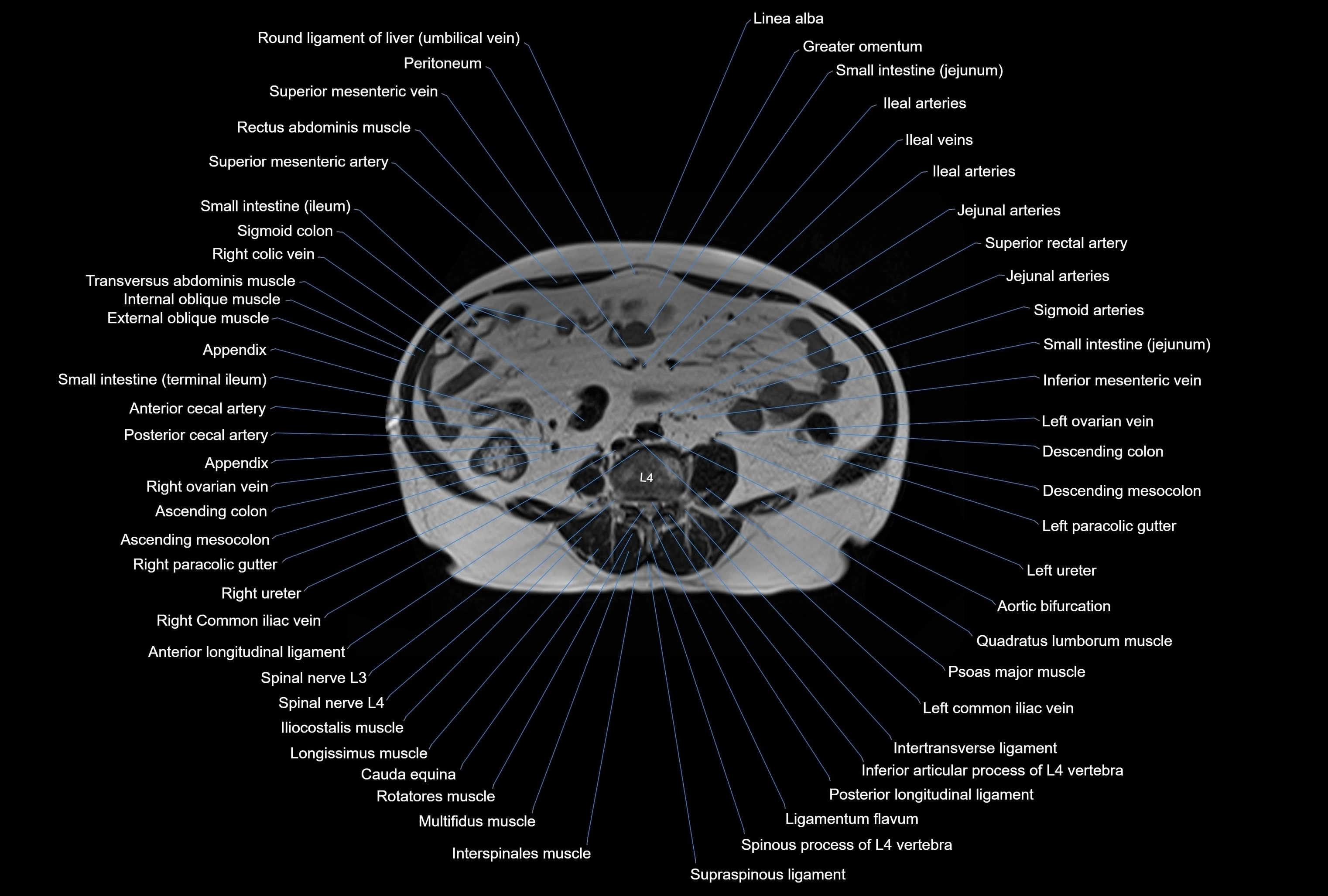 MRI Abdomen axial cross sectional anatomy radiology  image-img-00001-00032.webp